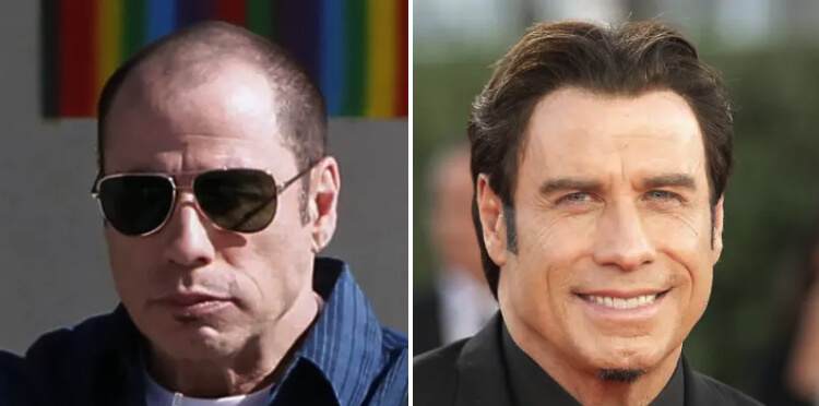 Top 20 Famous Celebrity Hair Transplants Before And After