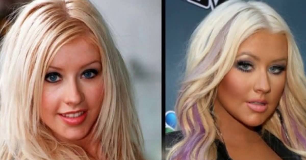 20 Most Influencing Best Plastic Surgery Before And After