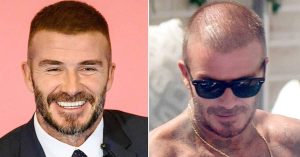 Read more about the article Top 20 Famous Celebrity Hair Transplants Before  And After