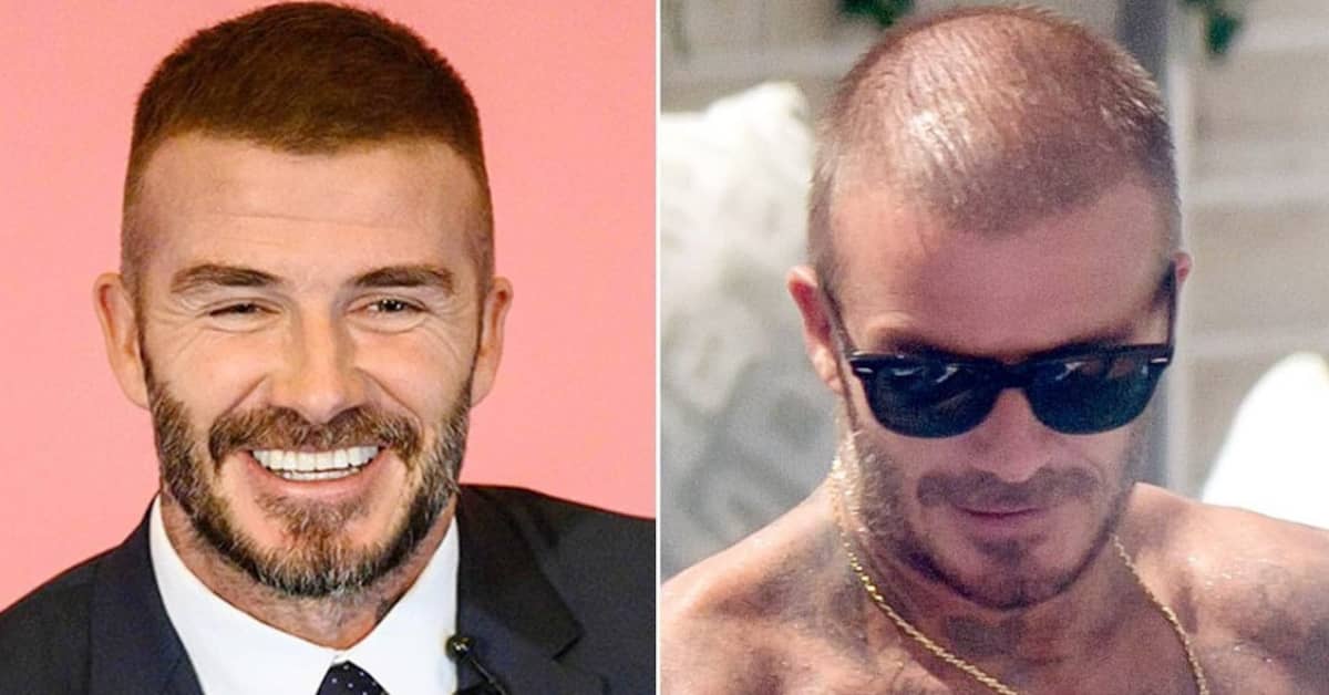 Top 20 Famous Celebrity Hair Transplants Before  And After