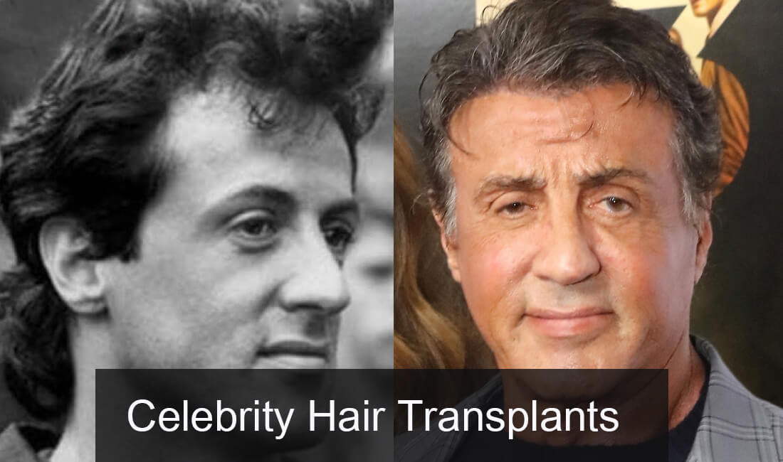 Celebrity Hair Transplants