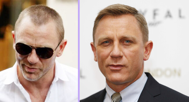 Top 20 Famous Celebrity Hair Transplants Before And After. www.styleitfit.c...
